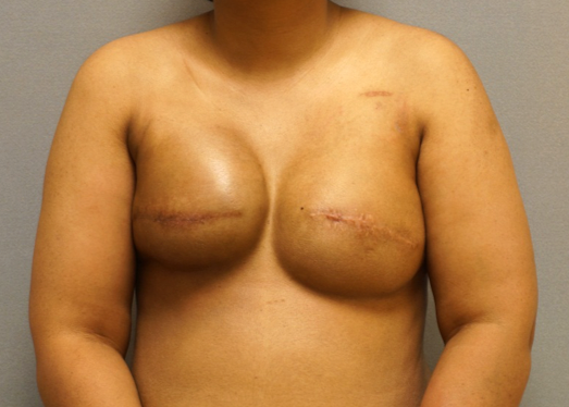 Photo of woman with right capsular contracture after implant-based breast reconstruction