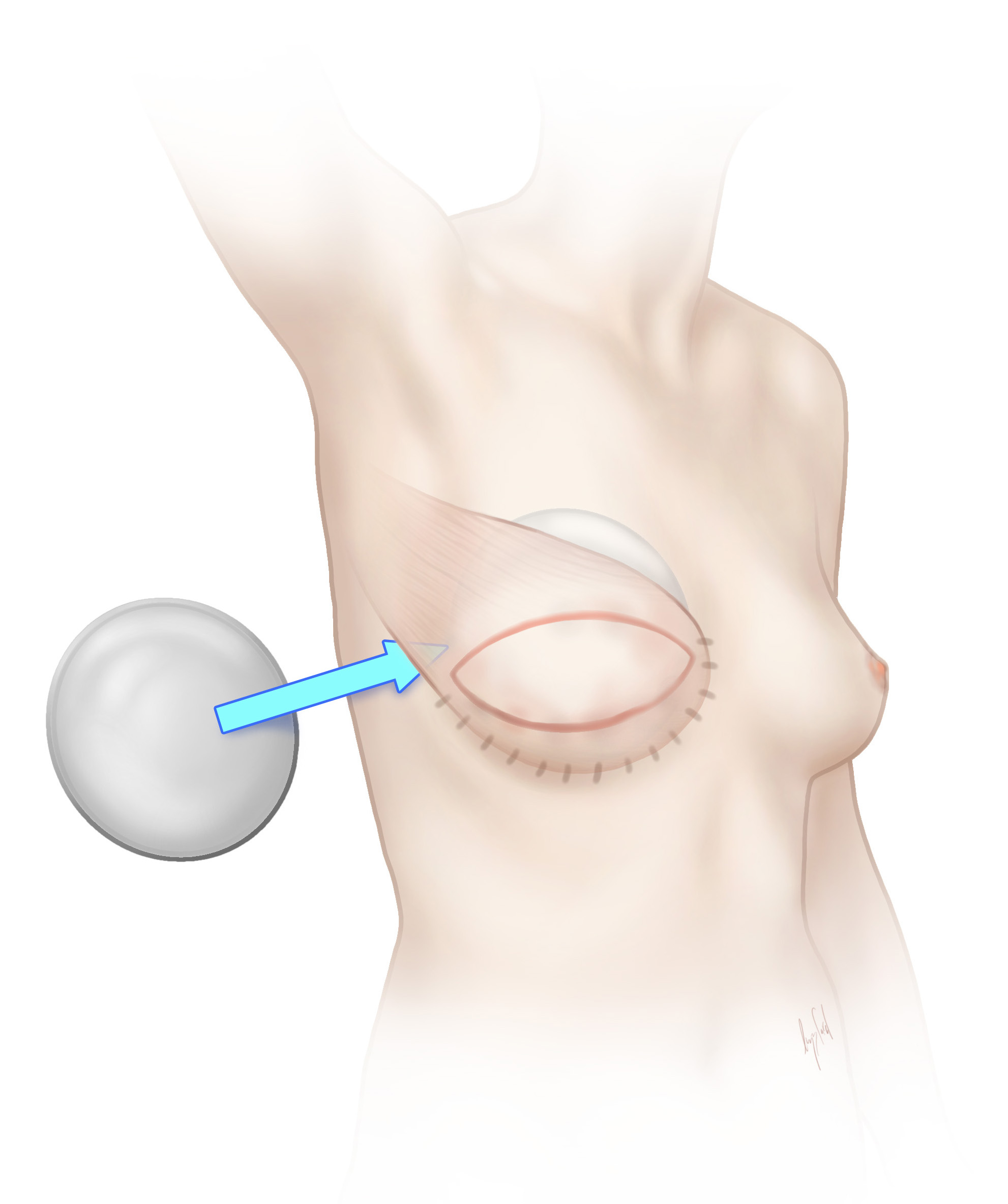 Illustration of combined tissue and implant breast reconstruction