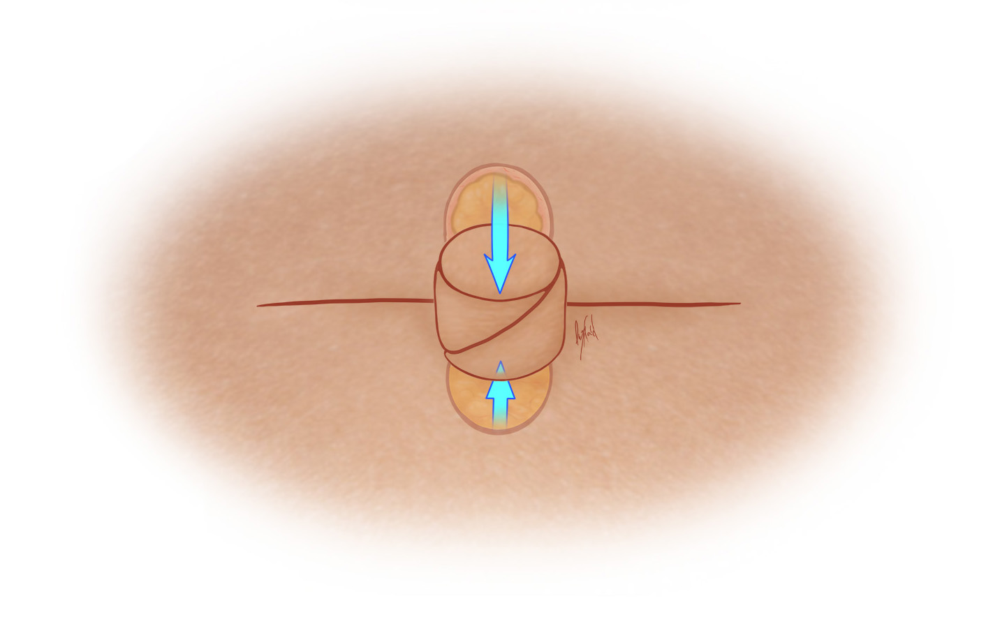 Surgically Recreated Nipple