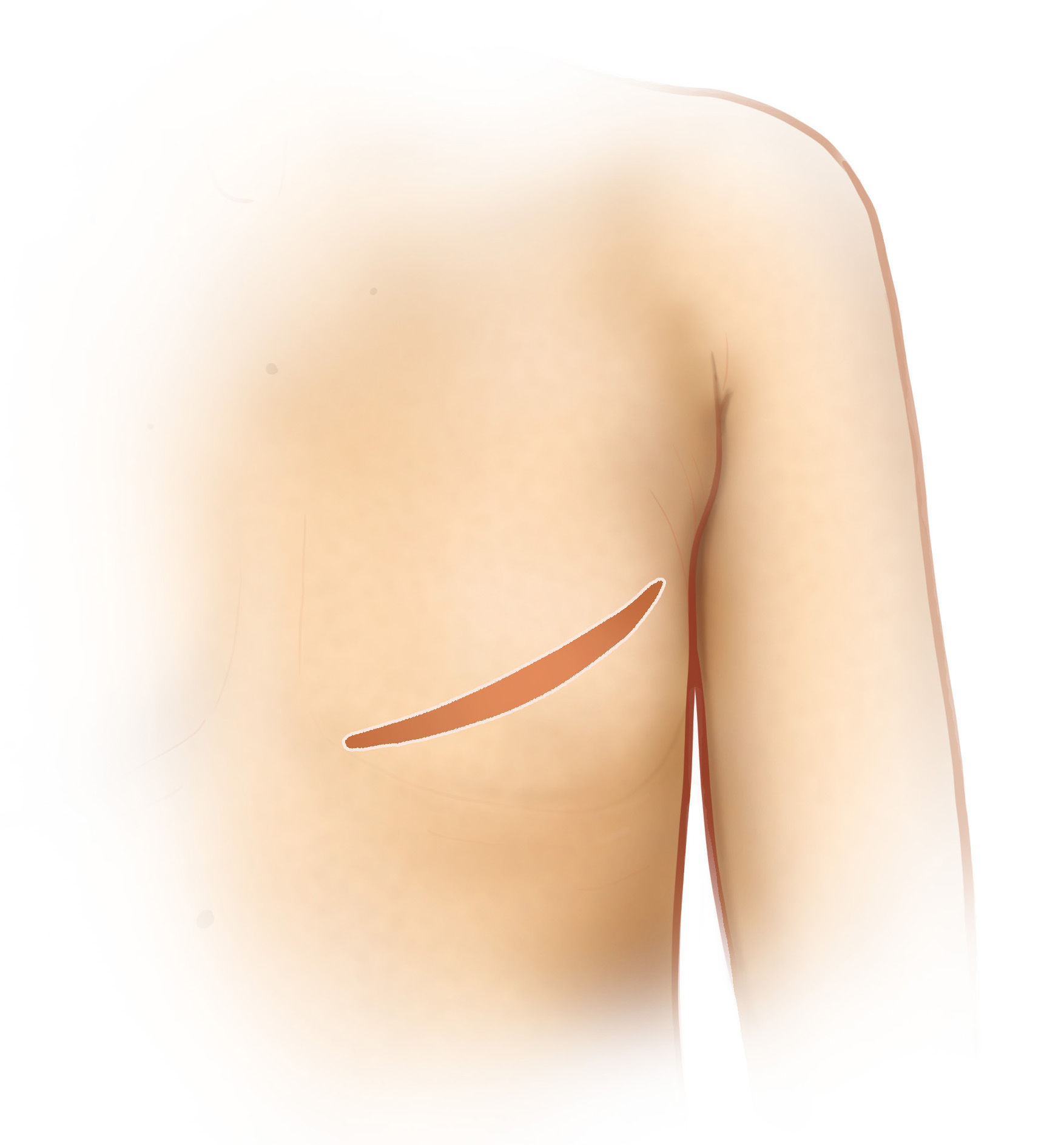 Simple mastectomy without reconstruction