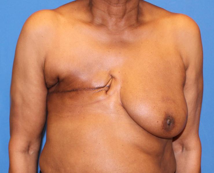Photo of woman with right breast removed and no reconstruction.
