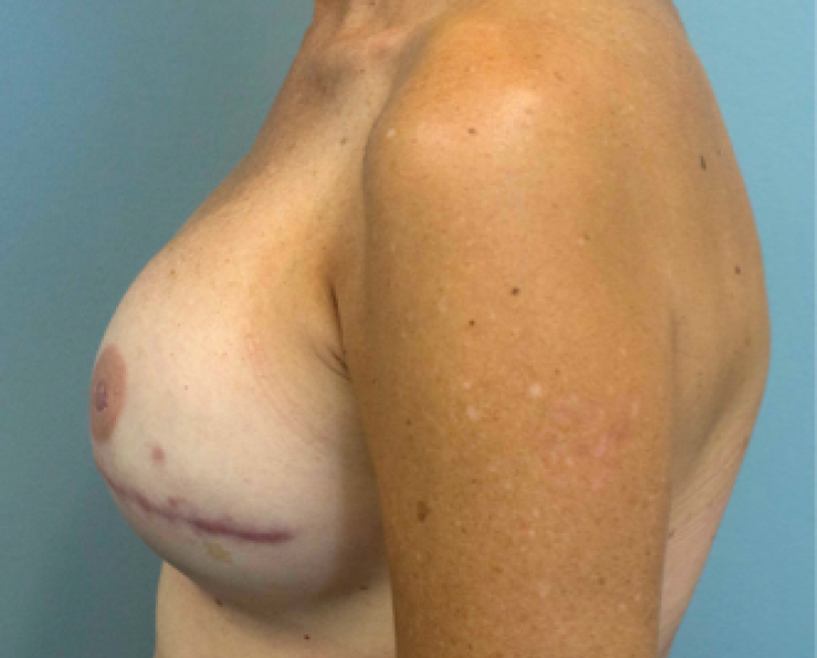 Photo of woman with reconstructed breasts and nipple tattoo as seen from the side.