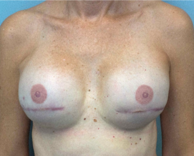 Photo of woman with reconstructed breasts and nipple tattoos