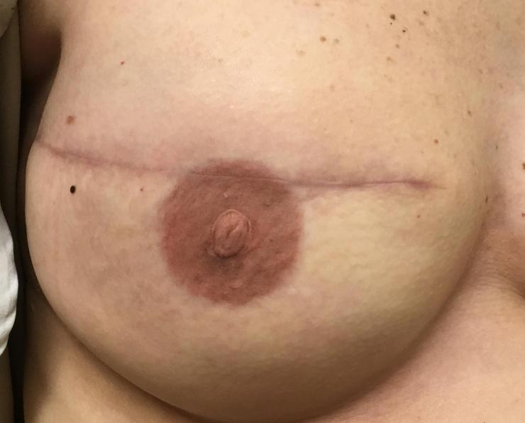 Photo of reconstructed breast with nipple tattoo courtesy of the Sauler Institute of Tattooing