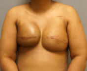 Photo of woman with right capsular contracture after implant-based breast reconstruction