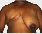 A woman with just one breast removed