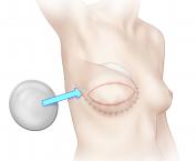 Illustration of combined tissue and implant breast reconstruction